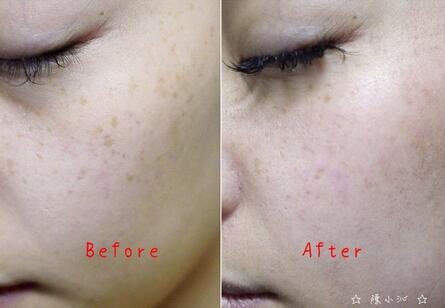 北京悅秀醫(yī)療整形專家楊勇山做激光去黃褐斑效果怎么樣?真實案例展示