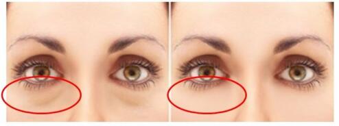 上海天美醫(yī)療美容門診部祛眼袋