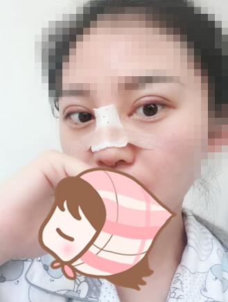 術(shù)后60天效果。