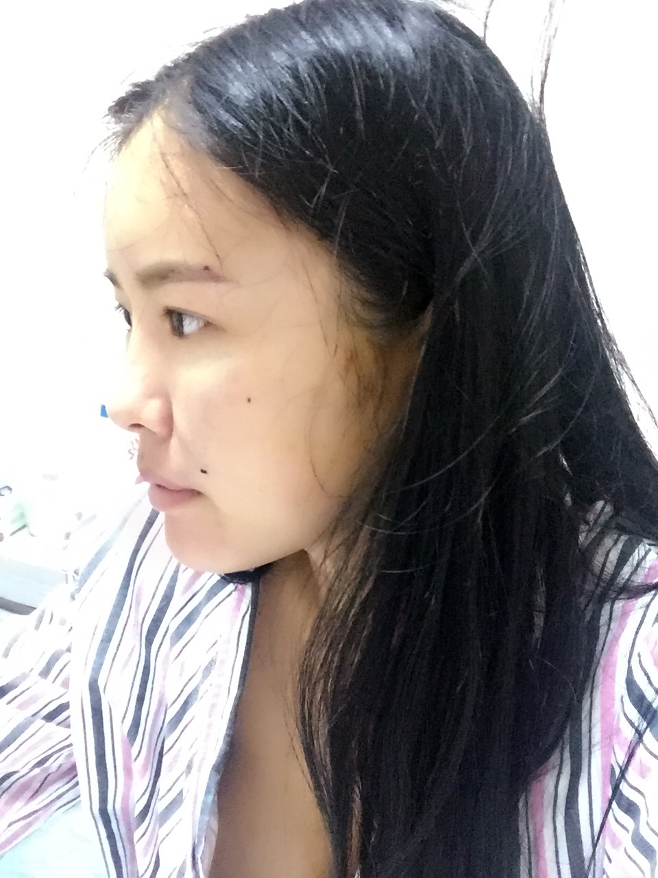 西安莎曼妃醫(yī)療美容醫(yī)院醫(yī)生樸俊做自體脂肪豐太陽穴效果怎么樣? 西安莎曼妃醫(yī)療美容醫(yī)院醫(yī)生樸俊做自體脂肪豐太陽穴效果怎么樣?