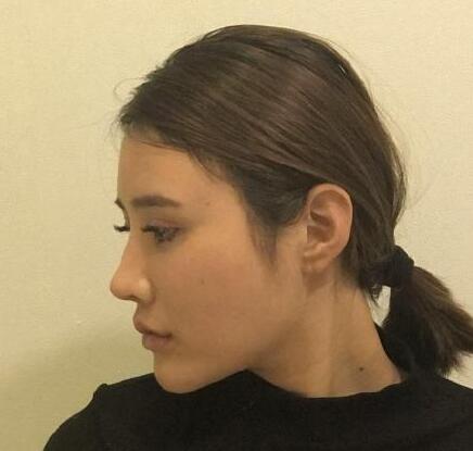 下頜角手術(shù)第一天：