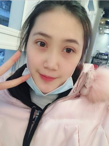 昆明大華醫(yī)療美容醫(yī)院做切開雙眼皮怎么樣？切開雙眼皮案例分享