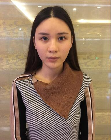 北京藝星整形專家郭峰做假體隆鼻修復(fù)怎么樣？郭峰假體隆鼻修復(fù)案例