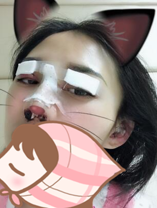 北京延世醫(yī)療整形專家周宜國做開外眼角技術(shù)怎么樣?周宜國開外眼角案例分享