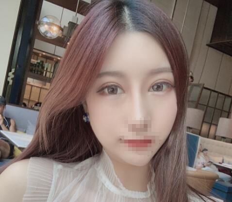 鼻綜合整形手術(shù)恢復(fù)效果