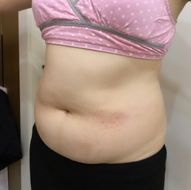 廣州星團(tuán)醫(yī)學(xué)整形醫(yī)生顧鵬做腹部吸脂效果怎么樣？顧鵬腹部吸脂案例展示