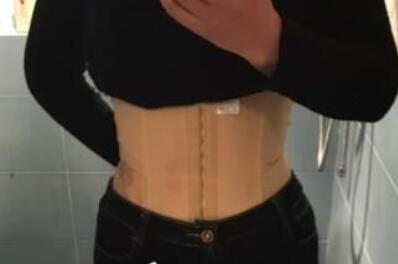 顧鵬腹部吸脂案例展示