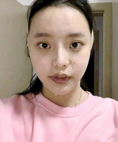 磨骨效果圖 磨骨效果圖