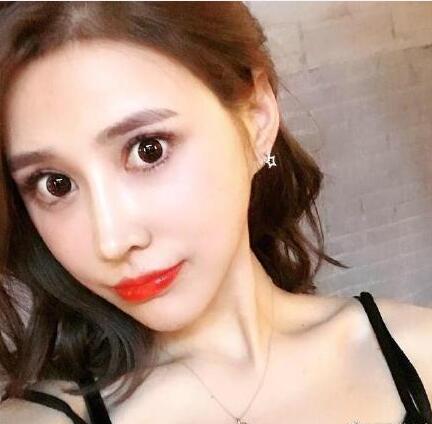 下頜角手術(shù)15天