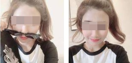 昆明麗都整形醫(yī)生孟春麗做面部自體脂肪填充效果怎么樣？