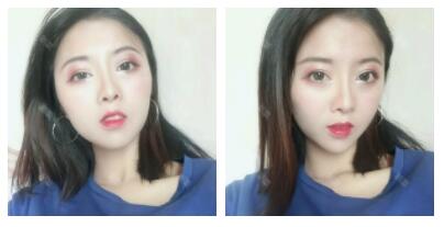 深圳嶺南醫(yī)院整形醫(yī)生丁祖鑫做假體豐太陽穴案例效果對比圖