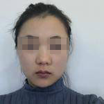 上海瑞麗整形醫(yī)生金炳建做肋軟骨隆鼻技術(shù)怎么樣？金炳建做肋軟骨隆鼻案例