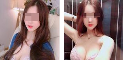 沈陽杏林整形美容醫(yī)院崔昌墉醫(yī)生做假體隆胸技術(shù)怎么樣？附案例