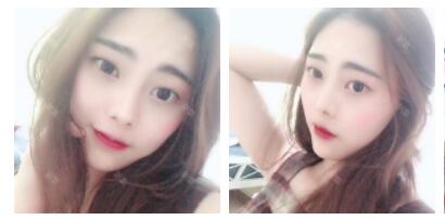 上海首爾麗格整形醫(yī)生魯峰一做自體脂肪全臉填充