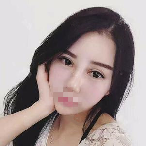 東莞維多利亞做硅膠隆鼻怎么樣？整形醫(yī)生李剛硅膠隆鼻案例分享