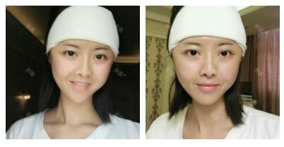 深圳嶺南醫(yī)院整形醫(yī)生丁祖鑫做假體豐太陽穴案例效果對(duì)比圖