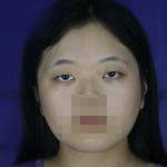 上海亞太醫(yī)療專(zhuān)家周聰做雙眼皮怎么樣？附周聰醫(yī)生雙眼皮案例