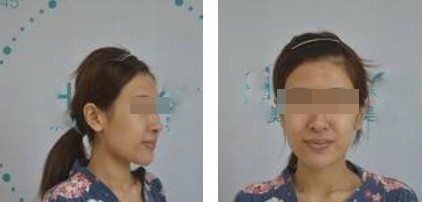 昆明麗都整形醫(yī)生孟春麗做面部自體脂肪填充效果怎么樣？