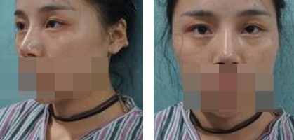 寧波美仁整形美容醫(yī)院李英大醫(yī)生做切開(kāi)雙眼皮效果怎么樣？