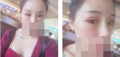 寧波美仁整形美容醫(yī)院李英大醫(yī)生做切開(kāi)雙眼皮效果怎么樣？