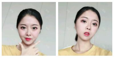 深圳嶺南醫(yī)院整形醫(yī)生丁祖鑫做假體豐太陽穴案例效果對(duì)比圖