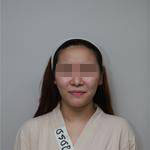 深圳尚虹醫(yī)療整形醫(yī)生藍(lán)劍雄做自體脂肪豐面頰效果怎么樣？附案例