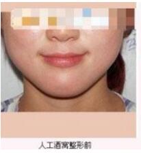 整形醫(yī)生張波濤酒窩成形術案例