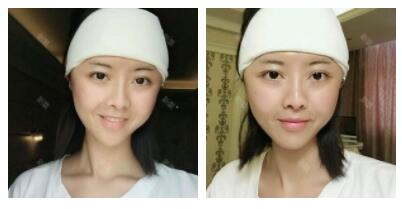 深圳嶺南醫(yī)院整形醫(yī)生丁祖鑫做假體豐太陽穴案例效果對比圖