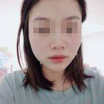 濟南曹博士美容整形醫(yī)院做玻尿酸豐面頰怎么樣？陳正喜醫(yī)生案例