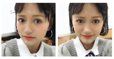 東莞華美做切開雙眼皮怎么樣？朱清武醫(yī)生切開雙眼皮案例分享