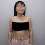 南寧伊美整形醫(yī)生凌宏量做自體脂肪隆胸怎么樣？自體脂肪隆胸案例