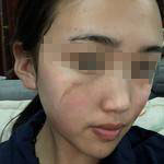 石家莊美然醫(yī)療整形醫(yī)生劉超做激光祛疤效果怎么樣？附劉超醫(yī)生案例