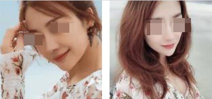 上海攸維醫(yī)療美容診所整形醫(yī)生李靜做膨體隆鼻效果怎么樣？附案例展示