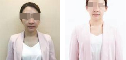 上海攸維醫(yī)療美容診所整形醫(yī)生李靜做膨體隆鼻案例展示 上海攸維醫(yī)療美容診所整形醫(yī)生李靜做膨體隆鼻案例展示