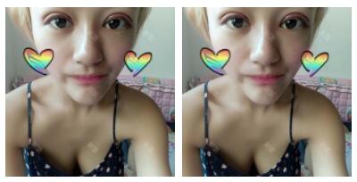 朱清武醫(yī)生切開(kāi)雙眼皮案例分享