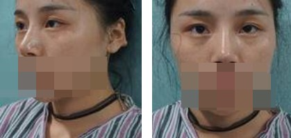 寧波美仁整形美容醫(yī)院李英大醫(yī)生做切開雙眼皮效果怎么樣？