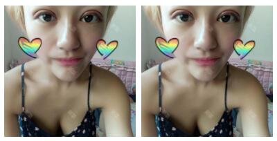 東莞華美做切開雙眼皮怎么樣？朱清武醫(yī)生切開雙眼皮案例分享