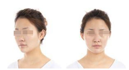 蘭州美月整形美容醫(yī)院文輝才醫(yī)生做鼻綜合整形效果怎么樣？附鼻綜合案例