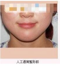 德州市第二人民醫(yī)院燒傷美容整形科張波濤醫(yī)生做酒窩成形術怎么樣？