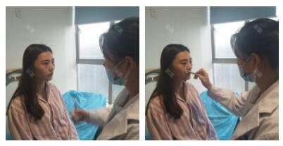 上海首爾麗格整形醫(yī)生魯峰一做自體脂肪全臉填充效果怎么樣？