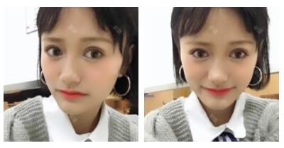 朱清武醫(yī)生切開(kāi)雙眼皮案例分享