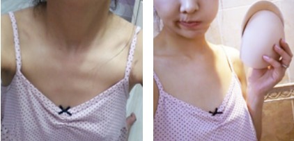 沈陽杏林整形美容醫(yī)院崔昌墉醫(yī)生做假體隆胸技術(shù)怎么樣？附案例