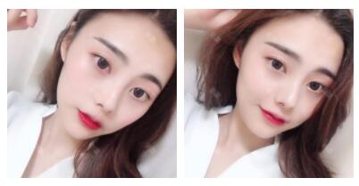 上海首爾麗格整形醫(yī)生魯峰一做自體脂肪全臉填充