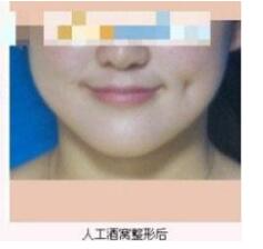 德州市第二人民醫(yī)院燒傷美容整形科張波濤醫(yī)生做酒窩成形術怎么樣？