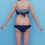 青島銘醫(yī)醫(yī)學(xué)整形醫(yī)生王殿棟做全身吸脂效果怎么樣？附案例展示