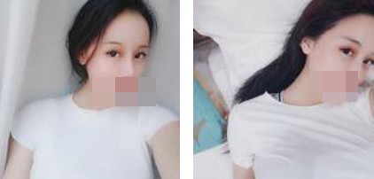 寧波美仁整形美容醫(yī)院李英大醫(yī)生做切開(kāi)雙眼皮效果怎么樣？