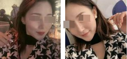 蘭州美月整形美容醫(yī)院文輝才醫(yī)生做鼻綜合整形效果怎么樣？附鼻綜合案例