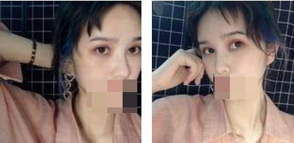 做了切開雙眼皮手術(shù)，才發(fā)現(xiàn)自己原來可以這么美！