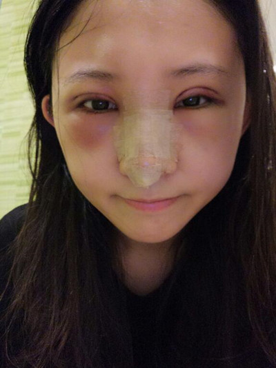 海南添美整形外科醫(yī)生王曉軍做自體軟骨隆鼻+雙眼皮+祛眼袋案例效果對比圖