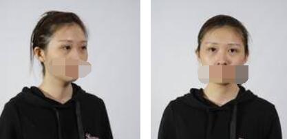 激光祛眼袋術(shù)前照片 激光祛眼袋術(shù)前照片